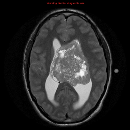 File:Central neurocytoma (Radiopaedia 13188-13206 Axial T2 4).jpg