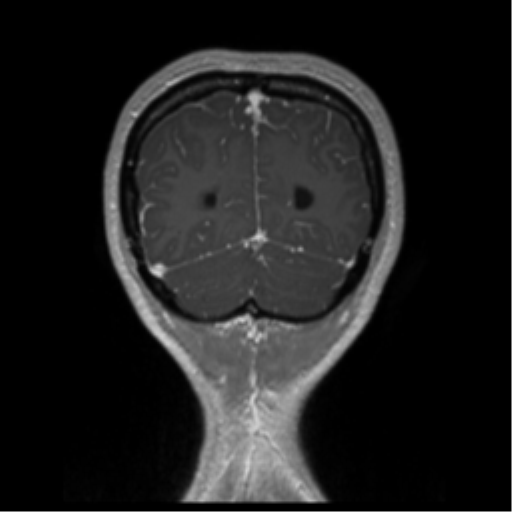 Central neurocytoma (Radiopaedia 37664-39557 Coronal T1 C+ 12).png