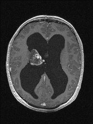 Central neurocytoma (Radiopaedia 56690-63469 Axial T1 C+ 95).jpg