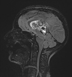 File:Central neurocytoma (Radiopaedia 84497-99872 Sagittal Flair + Gd 77).jpg