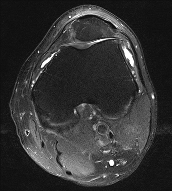 File:Central osteophyte (Radiopaedia 72592-83150 Axial PD fat sat 12).jpg