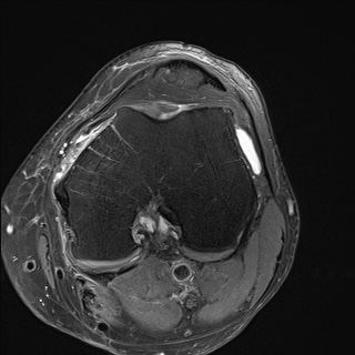 File:Central osteophyte (Radiopaedia 72592-83151 Axial PD fat sat 13).jpg