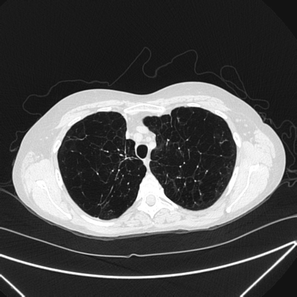 Centrilobular pulmonary emphysema (Radiopaedia 24495-24789 Axial lung window 22).jpg