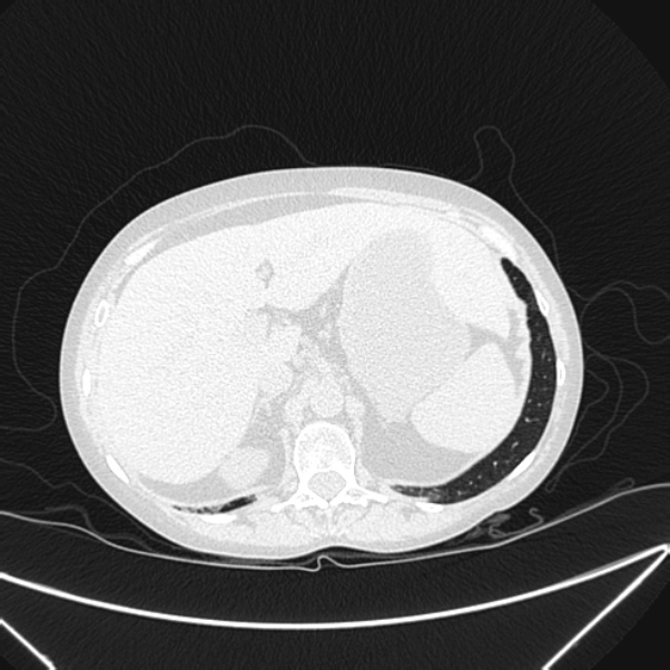 Centrilobular pulmonary emphysema (Radiopaedia 24495-24789 Axial lung window 89).jpg