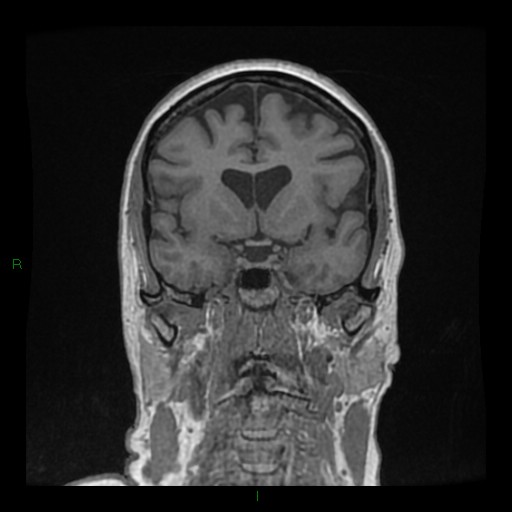 Cerebellar abscess (Radiopaedia 78135-90678 Coronal T1 C+ 64).jpg
