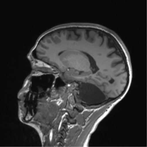 Cerebellar agenesis with hypoplastic pons (pontocerebellar hypoplasia) (Radiopaedia 57224-64138 Sagittal T1 29).png