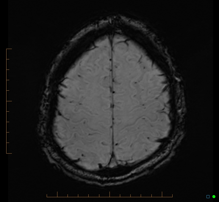 Cerebellar gangliocytoma (Radiopaedia 65377-74422 Axial SWI 50).jpg