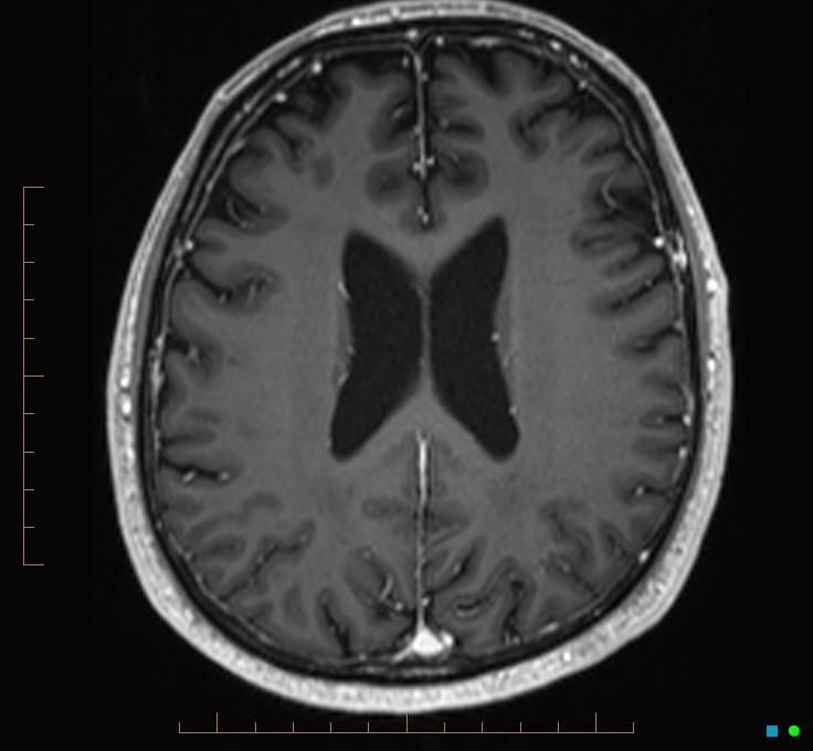 Cerebellar gangliocytoma (Radiopaedia 65377-74422 Axial T1 C+ 87).jpg