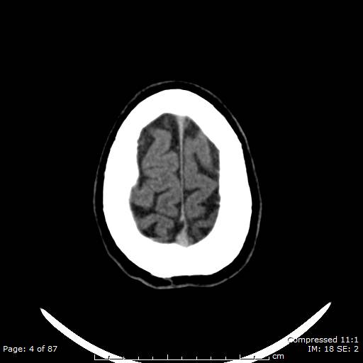 Cerebellar hemangioblastoma (Radiopaedia 52360-58258 Axial non-contrast 4).jpg