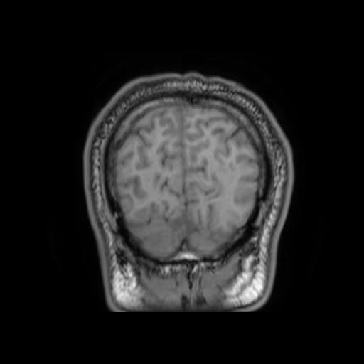 File:Cerebellar hemangioblastoma (Radiopaedia 88055-104622 Coronal T1 32).jpg