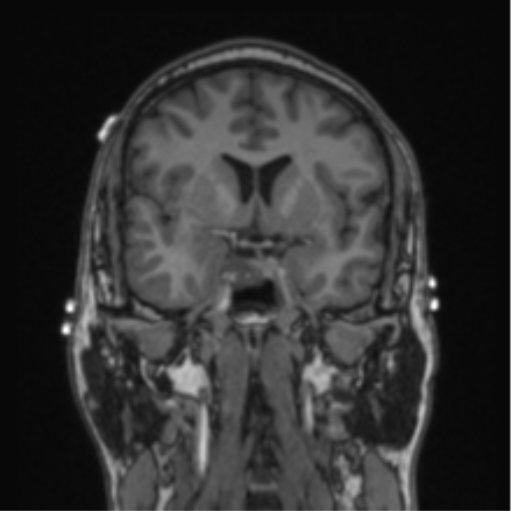 Cerebellar hemangioblastomas and pituitary adenoma (Radiopaedia 85490-101176 Coronal T1 56).png