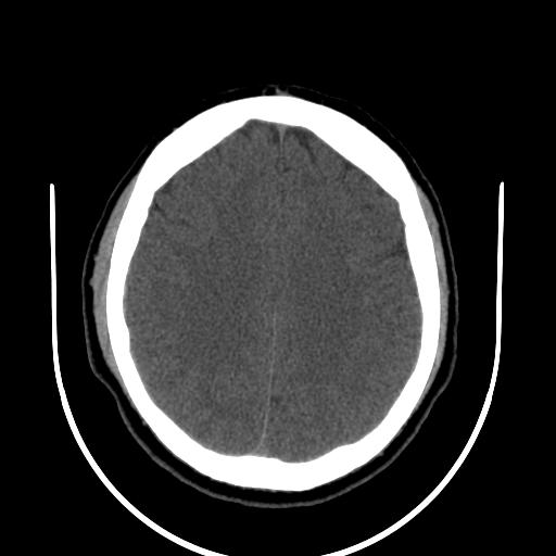 File:Cerebellar infarction (Radiopaedia 16625-16327 Axial non-contrast 26).jpg