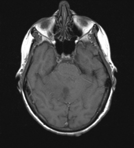 File:Cerebellar metastases (Radiopaedia 24038-24249 Axial T1 11).jpg