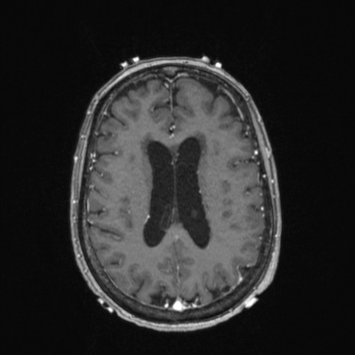 File:Cerebellar metastases (Radiopaedia 24038-24249 Axial T1 C+ 5).jpg