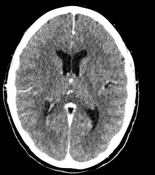 Cerebellar metastases - colorectal adenocarcinoma (Radiopaedia 40947-43652 Axial C+ 32).png