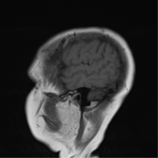 File:Cerebellar metastasis (Radiopaedia 54578-60810 Sagittal T1 2).png