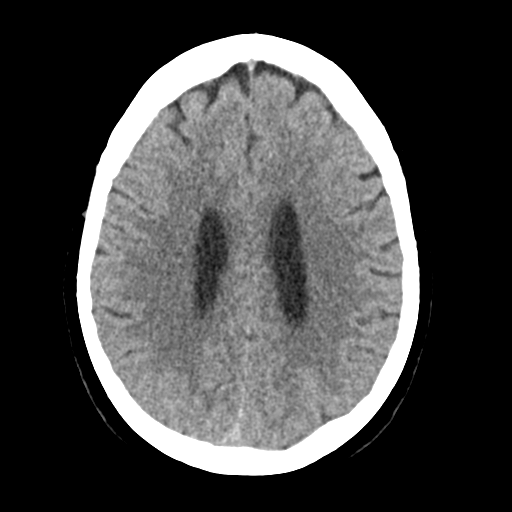 Cerebellar metastasis (Radiopaedia 54578-60812 Axial non-contrast 33).png