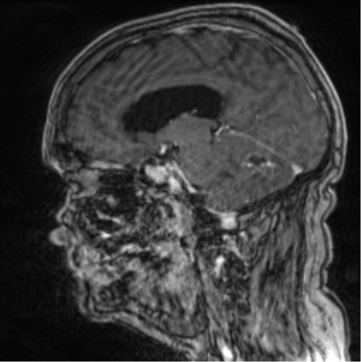 Cerebellar metastasis from lung adenocarcinoma (Radiopaedia 86690-102829 Sagittal T1 C+ 36).png
