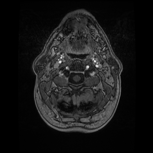 Cerebellar metastasis of pulmonary adenocarcinoma, cavernous venous malformation, and developmental venous anomaly (Radiopaedia 85827-101661 Axial T1 C+ 7).jpg