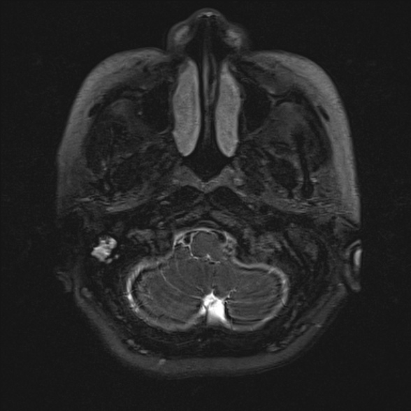 Cerebellopontine angle meningioma (Radiopaedia 53561-59591 Axial 3D volume T2 17).jpg