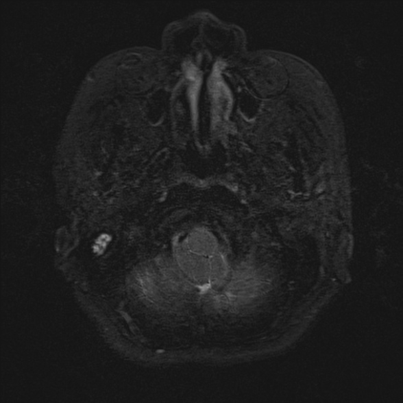 Cerebellopontine angle meningioma (Radiopaedia 53561-59591 Axial 3D volume T2 7).jpg