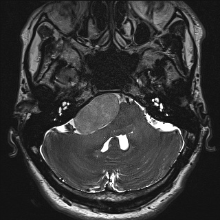 File:Cerebellopontine angle meningioma (Radiopaedia 72983-83680 Axial FIESTA 25).jpg