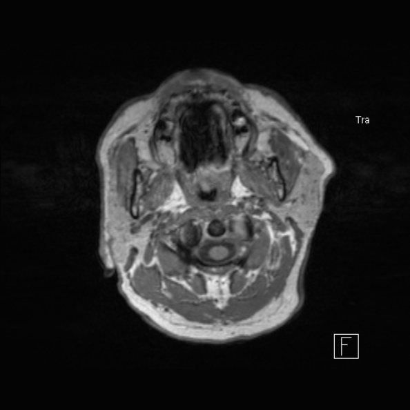 Cerebral abscess (Radiopaedia 26111-26247 Axial T1 9).jpg