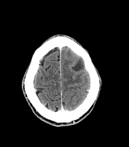 Cerebral abscess (Radiopaedia 57774-64741 Axial C+ delayed 53).png