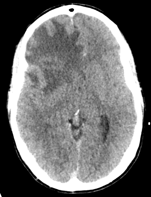 Cerebral abscess (Radiopaedia 60342-68008 Axial non-contrast 25).png