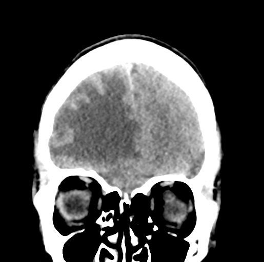 Cerebral abscess (Radiopaedia 60342-68008 Coronal non-contrast 13).png