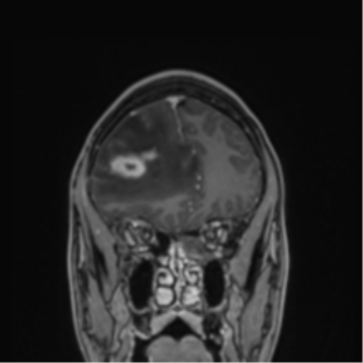 File:Cerebral abscess (Radiopaedia 60342-68009 H 41).png