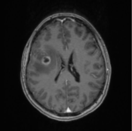 Cerebral abscess from pulmonary arteriovenous malformation (Radiopaedia 86275-102291 Axial T1 C+ 47).png