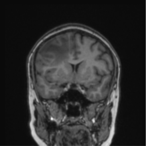 File:Cerebral abscess from pulmonary arteriovenous malformation (Radiopaedia 86275-102291 Coronal T1 58).png