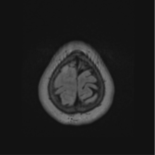 Cerebral abscess from pulmonary arteriovenous malformation (Radiopaedia 86275-102291 J 69).png