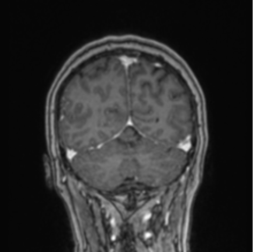 Cerebral abscess from pulmonary arteriovenous malformation (Radiopaedia 86275-102291 L 24).png