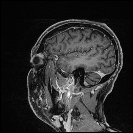 Cerebral abscess with ventriculitis (Radiopaedia 78965-91878 Sagittal T1 C+ 142).jpg