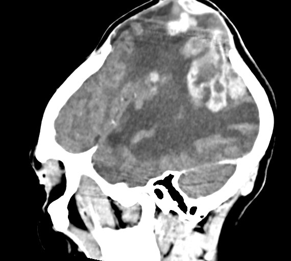 Cerebral abscesses (Radiopaedia 70458-80568 Sagittal Contrast 15).jpg