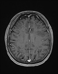 Cerebral amyloid angiopathy-related inflammation (Radiopaedia 58270-65377 Axial T1 C+ fat sat 101).jpg
