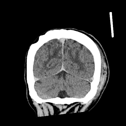 Cerebral amyloid angiopathy-related inflammation (Radiopaedia 74836-85848 Coronal non-contrast 59).jpg