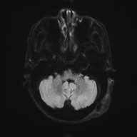 Cerebral amyloid angiopathy-related inflammation (Radiopaedia 74836-85849 Axial DWI 37).jpg