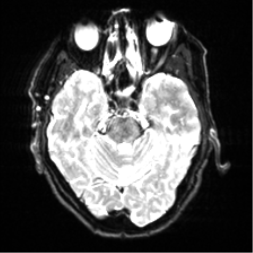 Cerebral amyloid angiopathy (Radiopaedia 46082-50433 Axial DWI 8).png