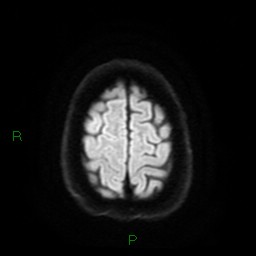Cerebral amyloid angiopathy (Radiopaedia 77506-89664 Axial DWI 25).jpg