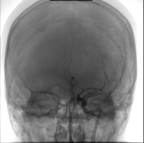 File:Cerebral angiographic projections (Radiopaedia 46308-50712 A 1).jpg