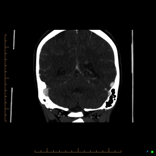 Cerebral arteriovenous malformation (AVM) (Radiopaedia 78162-90706 Coronal CTA 34).jpg