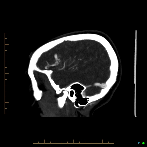 Cerebral arteriovenous malformation (AVM) (Radiopaedia 78162-90706 Sagittal CTA 17).jpg