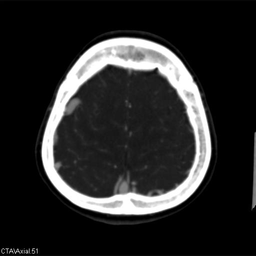 Cerebral arteriovenous malformation (Radiopaedia 28518-28759 B 51).jpg