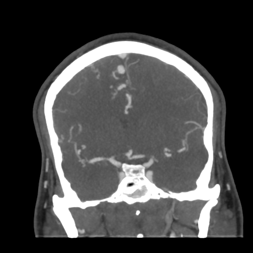 Cerebral arteriovenous malformation (Radiopaedia 39259-41505 E 28).png