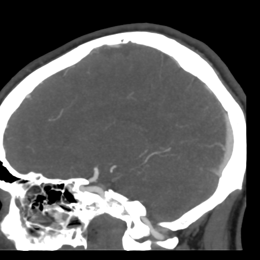 Cerebral arteriovenous malformation (Radiopaedia 39259-41505 Sagittal 36).png