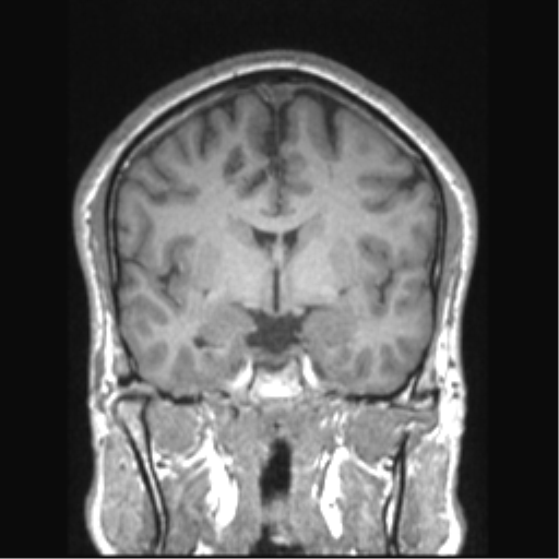 File:Cerebral arteriovenous malformation (Radiopaedia 39259-41506 Coronal T1 53).png