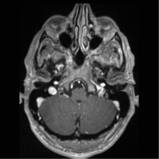 Cerebral arteriovenous malformation (Radiopaedia 55798-62372 Axial T1 C+ 13).png